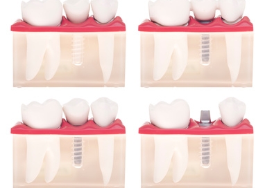 Implant dental