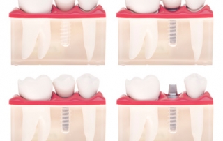 Implant dental